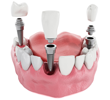 Implant Dentar